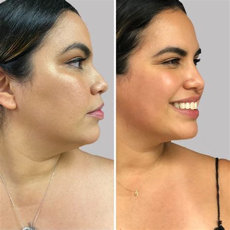 sono bello neck before and after pictures|arm liposuction before and after pictures.